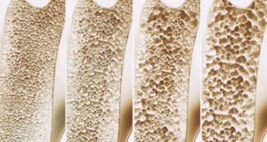 Osso con osteoporosi